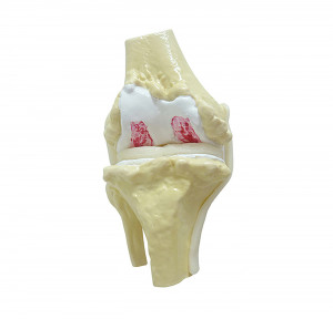 JOELHO COM OSTEOARTRITE AVANÇADO - cód. 9597-4