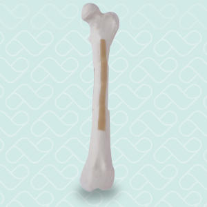 FEMUR ESPONJOSO COM FRATURAS MULTIPLAS 2  RADIOPACO - ESQUERDO - CÃO GRANDE - cód. 12718