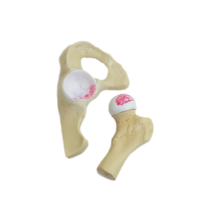 QUADRIL COM OSTEOARTRITE MODERADO - cód. 9598-3