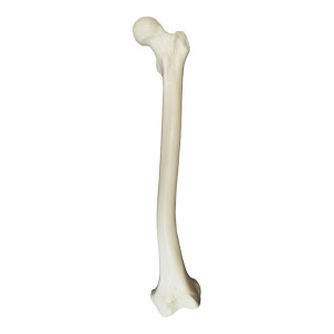 FEMUR DIREITO COM DEFORMIDADE DISTAL  SMA - cód. 2030 DD 