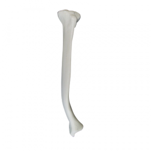 TÍBIA RADIOPACA DIREITA COM DEFORMIDADE DISTAL SMA - cód. 12436